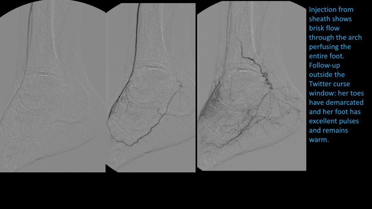 Watts_IR's tweet image. Outflow is essential in limb salvage! #MyLegMyLife #CLIFighters #2Tibs1Loop #OutpatientPAD #TwittIR
@CLI_Global @Mustapja @SIRRFS @SIR_ECS @FadiSaab17 @DrBTKatzen @pa_vascularinst @Drshiloh @drsavealimb
