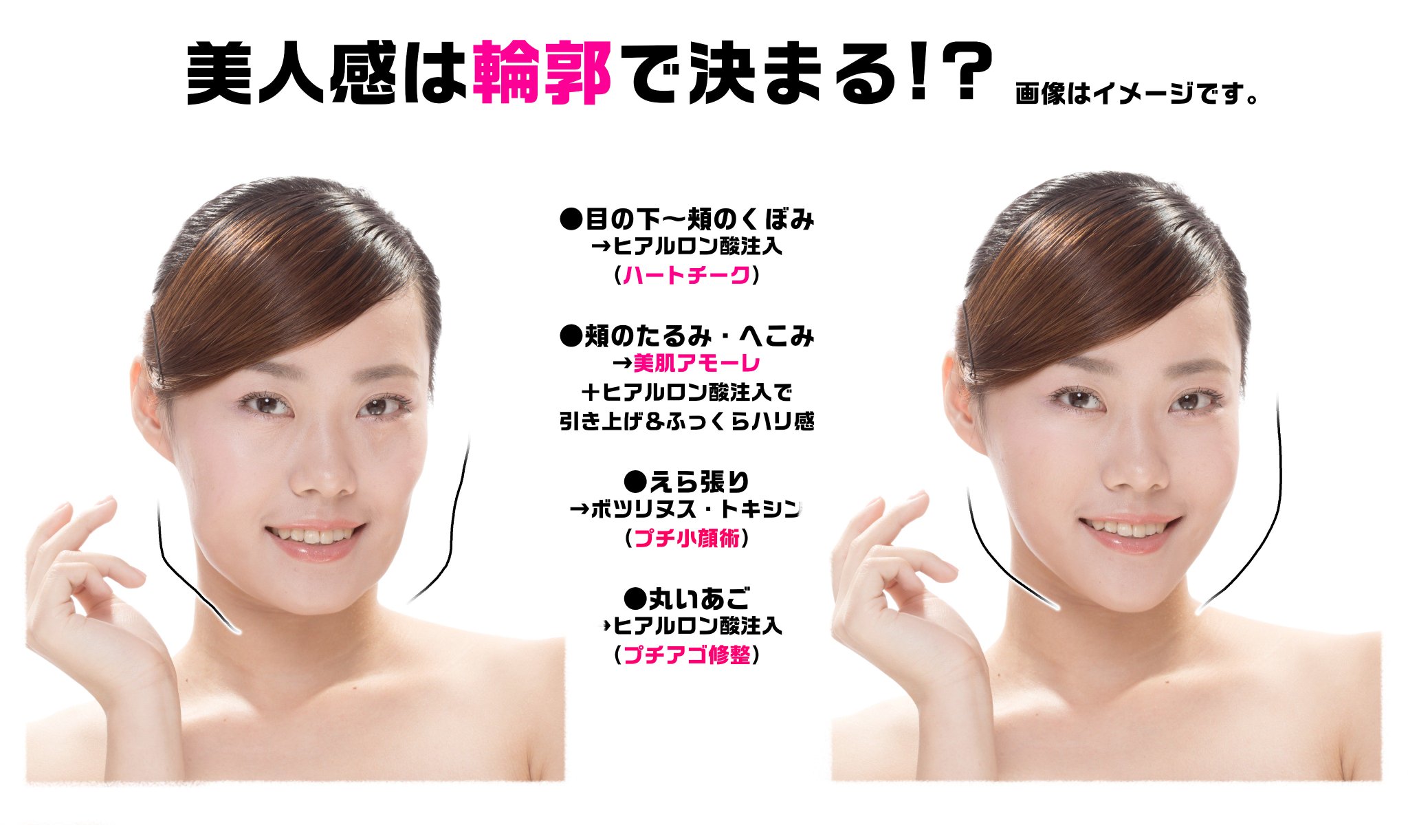 公式 品川美容外科 V Twitter 最近よくお問い合わせをいただく 輪郭 のメニューをまとめました 目の下 ホホ上が凹んでいるならハートチーク ホホ全体のたるみには美肌アモーレ ホホのこけにはヒアルロン酸 エラ張りさんにはボトックス アゴが丸っこい 高さが 公式 品川美容外科 V Twitter 最近よくお問い合わせをいただく 輪郭 のメニューをまとめました 目の下 ホホ上が凹んでいるならハートチーク ホホ全体のたるみには美肌アモーレ ホホのこけにはヒアルロン酸 エラ張りさんにはボトックス アゴが丸っこい 高さが