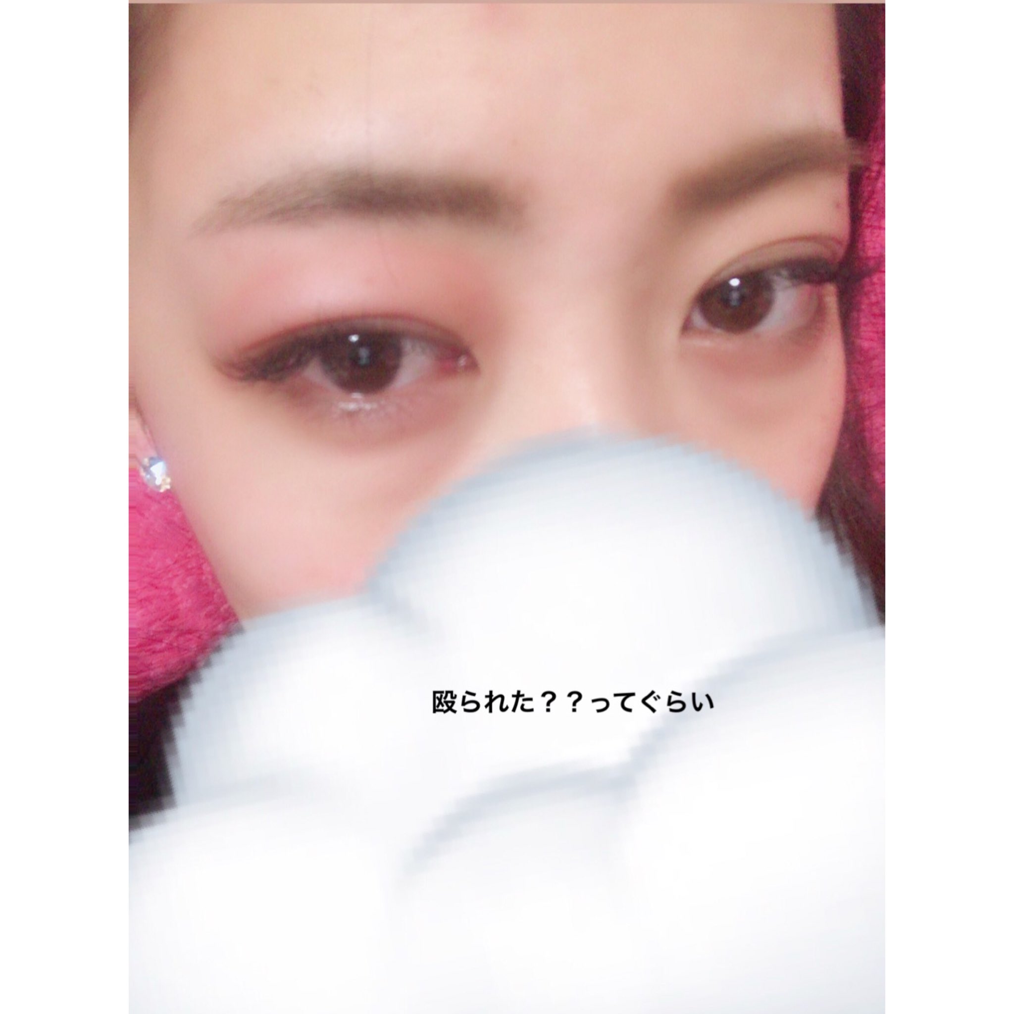 小濵千春  chiharu obama on X: 昨日の夜 左まぶただけ ぶくぶく腫れだして 今は少し治ったけどまだ腫れとる😔 痒くないから 虫刺されでは無いと思うけど 同じようになった事ある人おるとかな？？ とりあえず移動中だけ隠す🙍🏻‍♀️  t.coVrAlrpPSEg  X