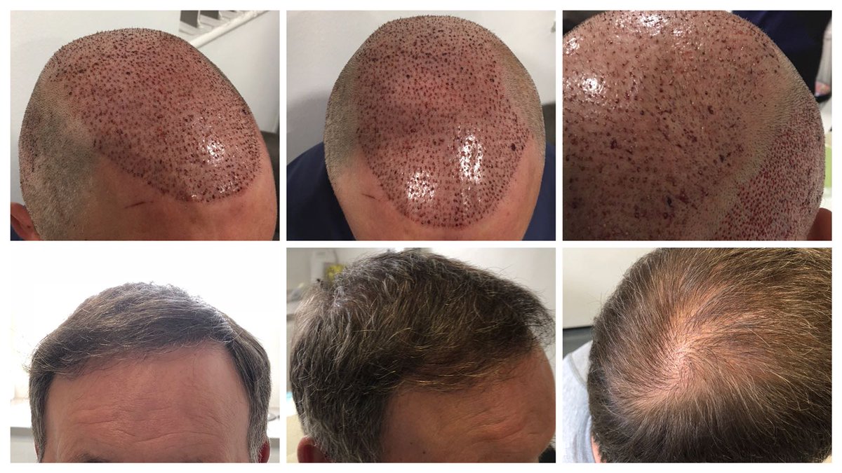 Dr Matee Hair Restoration On Twitter Dr Matee Is Glad To Restore