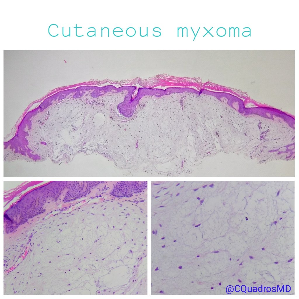 CQuadrosMD's tweet photo. Cutaneous Myxoma
🔹 dermal tumour
🔹 poorly circumscribed
🔹 abundant myxoid stroma
🔹 bland, stellate fibroblasts
🔹 thin-walled blood vessels
#pathology #softissuepath #dermpath https://t.co/YynzCirU2T