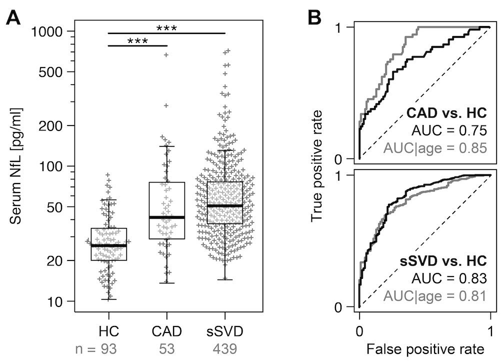 ISDneuroimaging's tweet photo. Small Vessel Disease burden is reflected in serum neurofilament light chain levels. 

In every study using serum NfL, be aware of SVD as a potential major confounder!

https://t.co/Uf6VO7yLET https://t.co/rinHU7cR2i