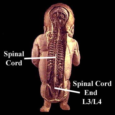 34. This is why I believe infants & children were the worst affected. The bottom of the infant spinal cord (the part that controls the legs) lies directly behind the intestines.
