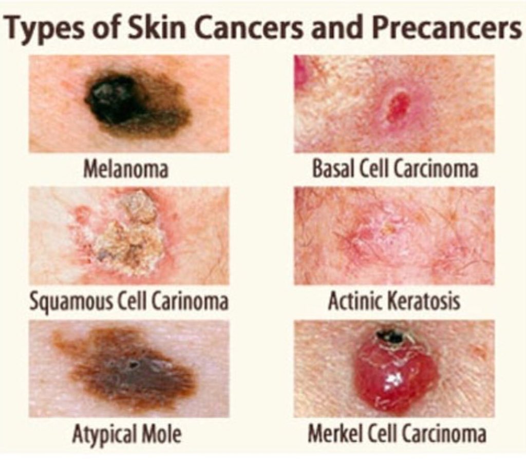 What Types Of Skin Cancer Are There 