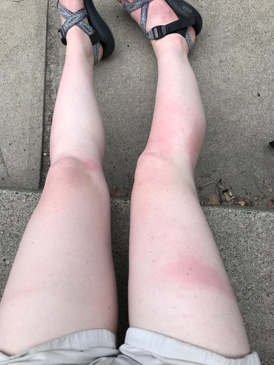 emilykestel's tweet photo. And for your enjoyment, here is a photo that shows off how poorly I applied sunscreen today. #splotchy https://t.co/hYzNP2CodG