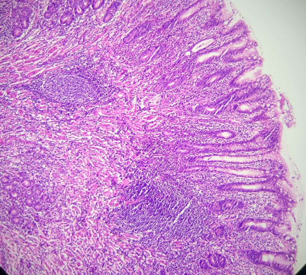Andy_pathology's tweet image. Stomach, hamarToma polyp. #Stomachpath