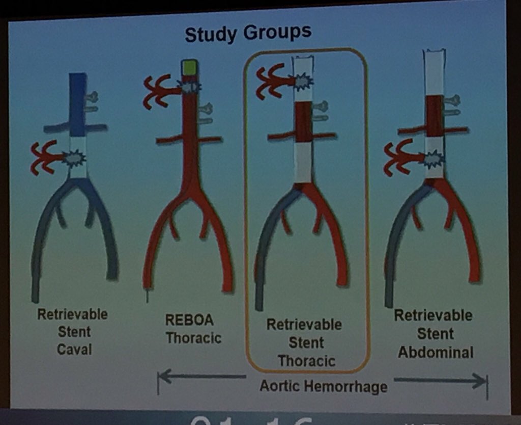 Matthew Boylan (@phemdoc) on Twitter photo Retrievable endovascular stents for aortic or caval injury - the next tool for forward/pre-hospital non-compressible haemorrhage control?. No need for total occlusion like #REBOA . Exciting <a href="/USDOD/">US Dept of Defense</a> funded research project #EVTM2018 Retrievable endovascular stents for aortic or caval injury - the next tool for forward/pre-hospital non-compressible haemorrhage control?. No need for total occlusion like #REBOA . Exciting <a href="/USDOD/">US Dept of Defense</a> funded research project #EVTM2018