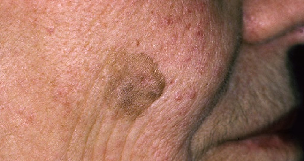 Webmd Seborrheic Keratosis Can Appear Almost Anywhere On Your Body Especially After Middle Age What To Know About The Tan Or Brown Spots T Co Mm7cc5ukkp T Co Roizfmvknm Twitter