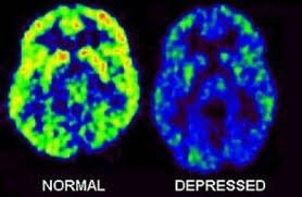 LASpinecare's tweet photo. Depression is a serious illness that can place your life at risk, as much as a brain tumor or an aneurysm.  Help is available.  https://t.co/odYI5QStft   and https://t.co/EnXDMua8Tb …
#anthonybourdain #katespade https://t.co/RJZTPKPdV5