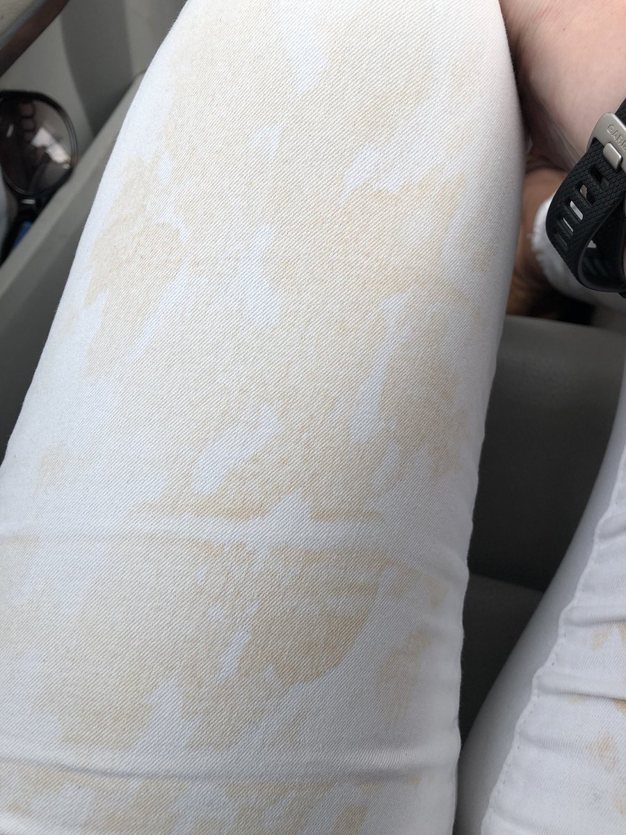 PriomhoideIrl's tweet photo. Major tan fail after a downpour in Cork. I don’t know if I should laugh or cry. #tan #tanfail #eveningruined Homeward bound. https://t.co/TLFuPmfWYt