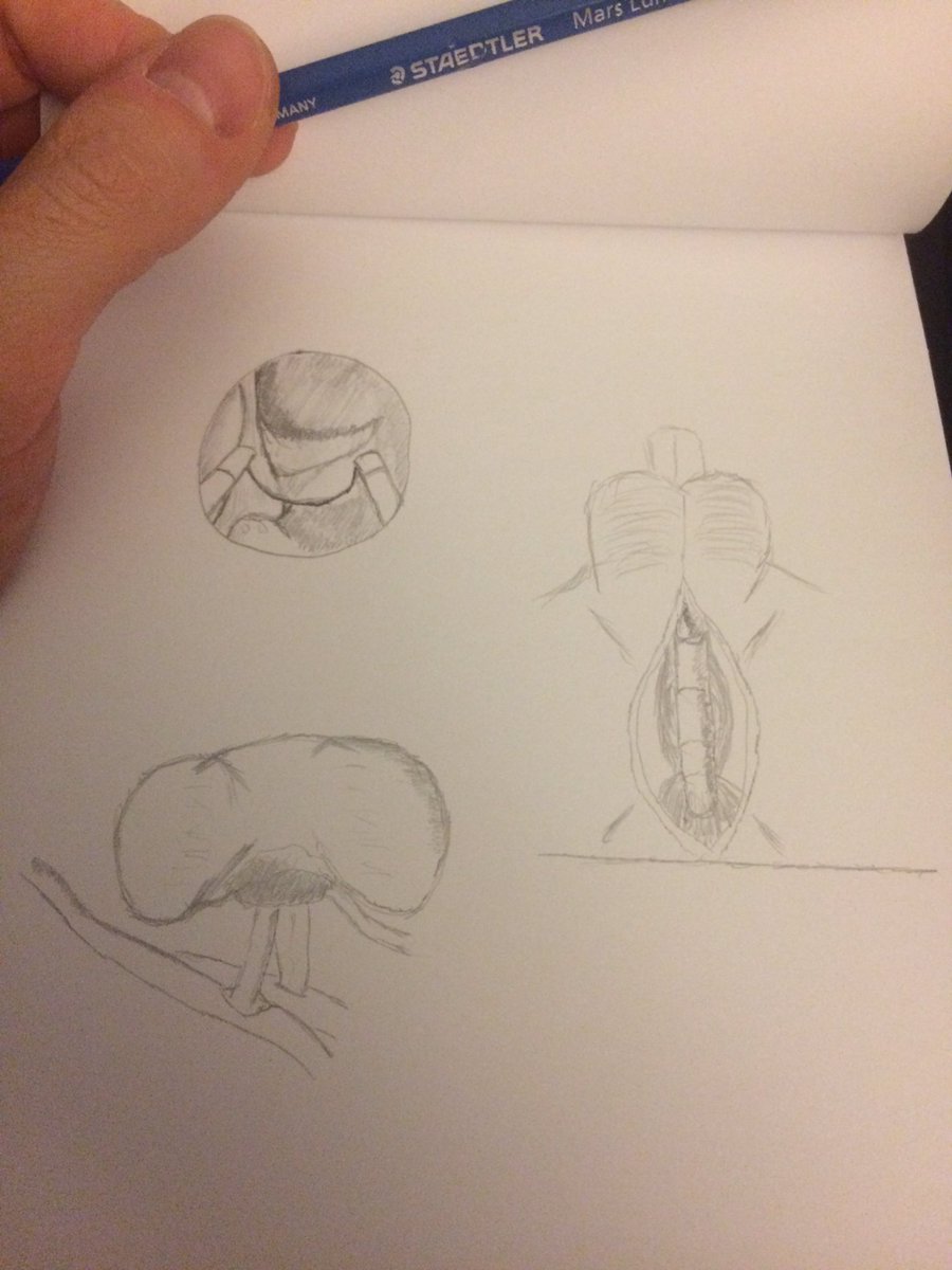antonio_tienza's tweet photo. Last week surgeries draws....✏️ #TURP #tueb #renaltransplantation #urethroplasty #Urology #sketchbook (trying to learn something of @fabriziodalmoro) https://t.co/3YN7jQwS3J