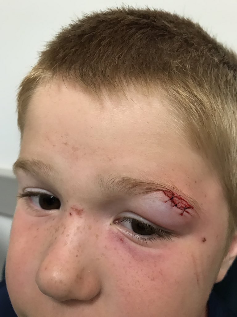 rrincker's tweet photo. Two kids, 3 stitches, 3 staples, 2 different days.  #goodrunofbadluck https://t.co/TBnnha63Mv