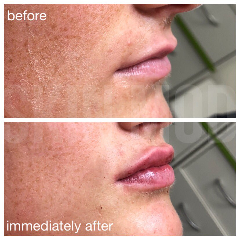 skinmodclinic's tweet photo. Beautiful lip enhancement done by our very own Dr Sidra using #juvaderm to create that #perfectpout at #skinmod
#lipfillers #lipinjections #lips #injections #fillers #botox #antiageing #perfection #happy #beautiful #safe #pout #client #aesthetic #clinic #romford #essex #treatment https://t.co/VLdheoE0N6
