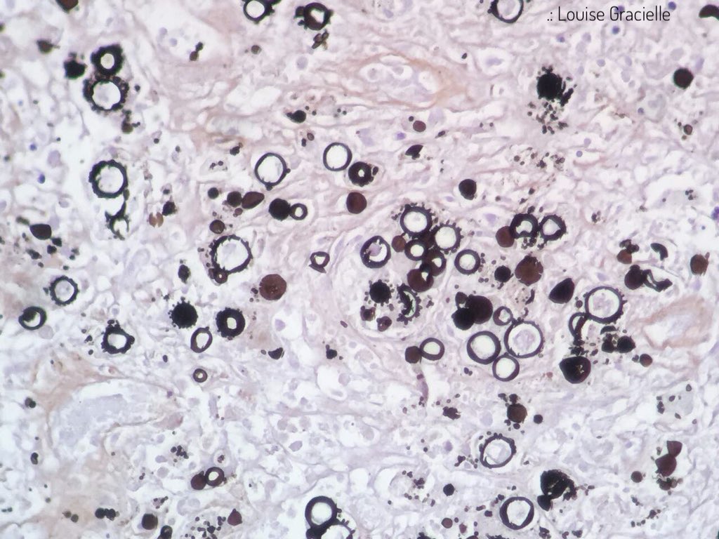 LouiseGracielle's tweet image. It looks like Paracoccidioides brasiliensis is throwing a party to which I wasn’t invited. 🎉🔅🔆🔅🎉
(Thank God! 😬) 

#Lymphnode #Yeasts #Paracoccidioidesbrasiliensis #Grocott #Pathology #ItLooksLikeAPainting