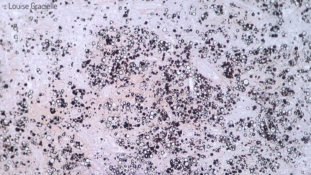 LouiseGracielle's tweet image. It looks like Paracoccidioides brasiliensis is throwing a party to which I wasn’t invited. 🎉🔅🔆🔅🎉
(Thank God! 😬) 

#Lymphnode #Yeasts #Paracoccidioidesbrasiliensis #Grocott #Pathology #ItLooksLikeAPainting