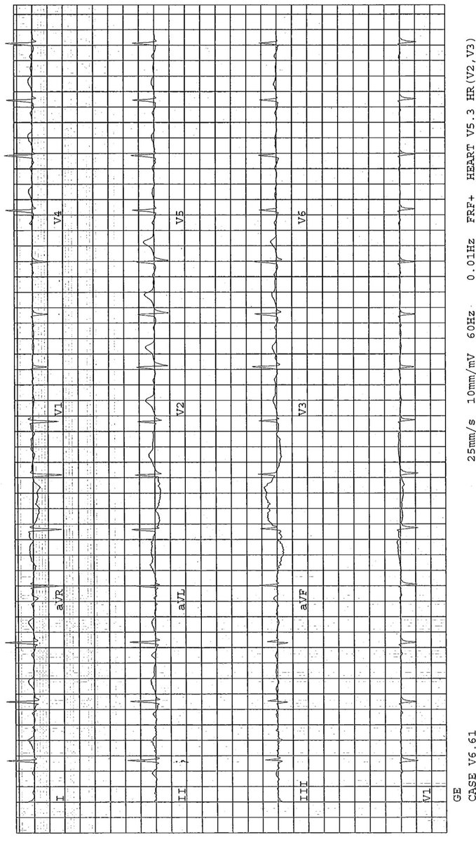 56 M HTN/LVH ETT 50s into recovery has VT likely SOO ? Lateral MA or ALPM. CCTA and XA normal Cors. TTE EF 55%, mild PMVL prolapse. Next steps and SOO of VT. Cardiac MRI, ILR ( burden etc), BB.