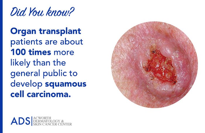 Did You Know?
Organ transplant patients are approximately 100 times more likely than the general public to develop squamous cell carcinoma. #SquamousCellCarcinoma