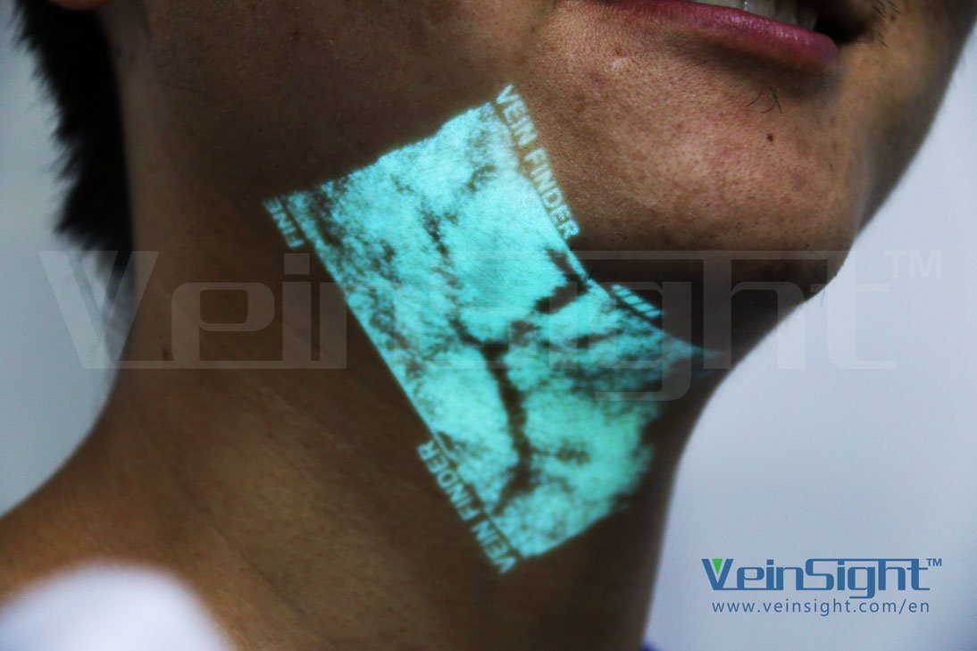 Vein Finder (@veinsight ) newly application picture on the face and the vein is so clearly. (See more: veinsight.com/en) #veinfinder #medicaldevice #Medical #medicalequipment #medtech #technology #medtech2017 #medicalstudent #medicalguide #Medicaid