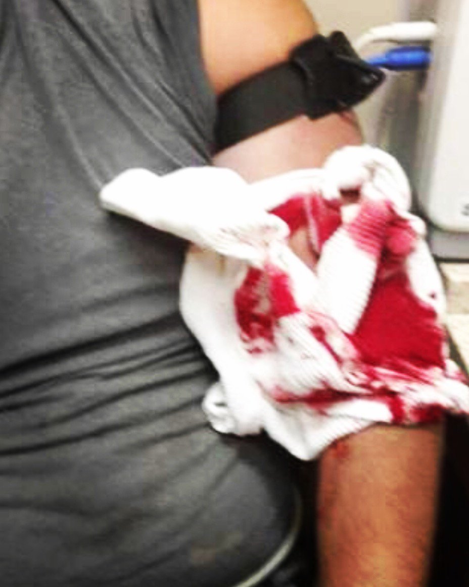 TacticalMedical's tweet photo. Grad from @TacRescueServ Tactical Incident Care & Skills Class applied #SOFTTW to coworker cut by circular saw, receiving praise from ER doc for quick thinking & proper application of the #tourniquet. “If I had never taken the class, I wouldn’t have been prepared for this.” #tccc https://t.co/TgxSVTsTwJ