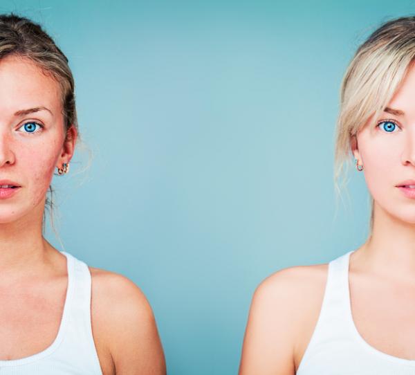 Cómo quitar las rojeces de la cara de forma natural - los mejores remedios belleza.uncomo.com/articulo/como-… #belleza