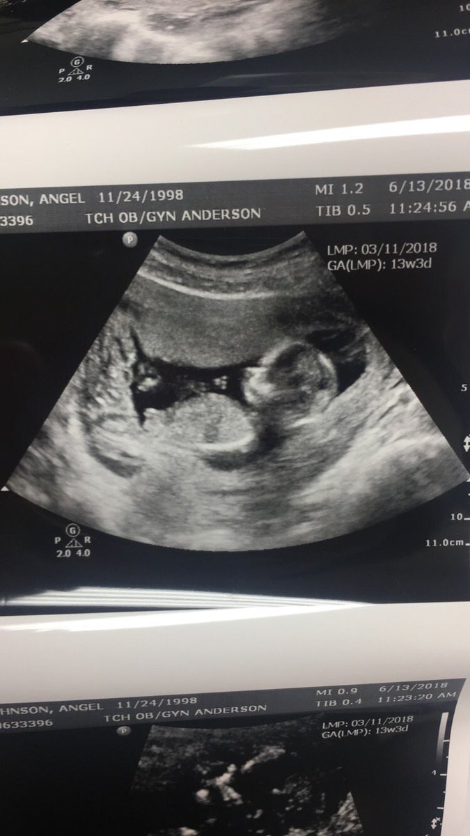 _AngelJohnson_'s tweet photo. can’t wait to meet you baby girl💓👶🏼 https://t.co/Dk962sDguE