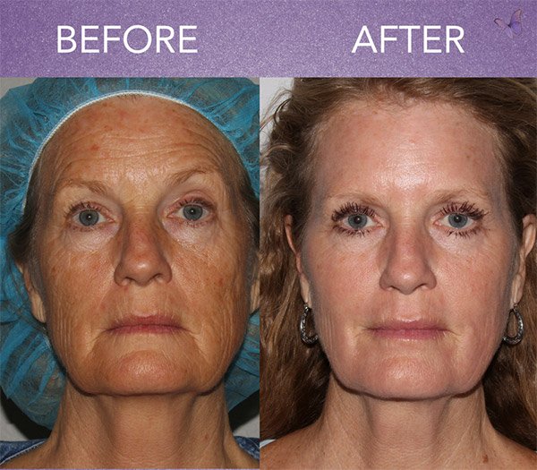 dr_sidmirrafati's tweet photo. Active FX Fractional Laser Resurfacing https://t.co/vKYVIv1mWw

#BenefitsofActiveFX #ActiveFXTips #MondayMotivation https://t.co/9EYgxvkpzh