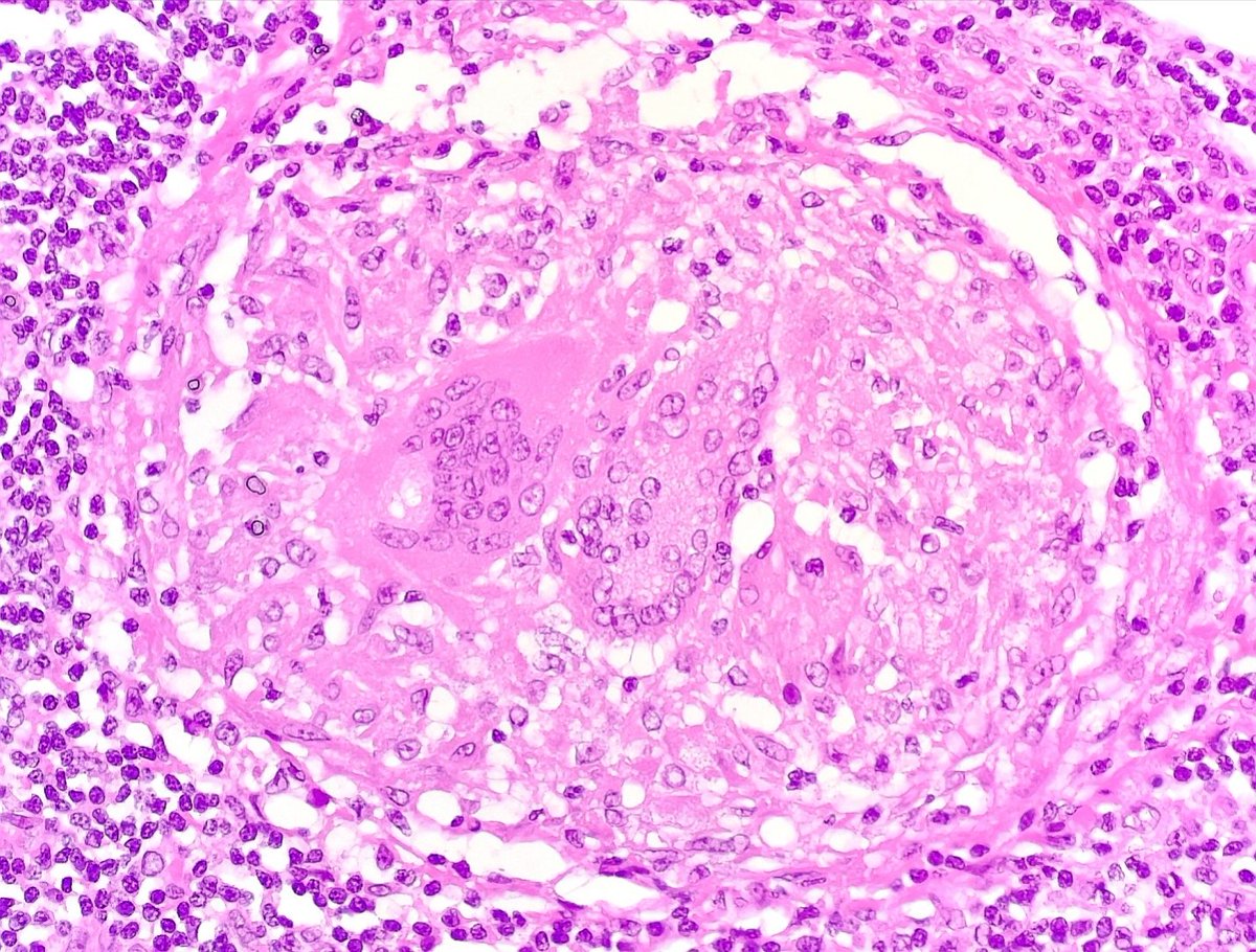 dr_MPrieto's tweet photo. #caseoftheday 37 yo👨🏻 with lymph node biopsy. 🔬: granulomatous lymphadenopathy suggestive of sarcoidosis. Well formed granulomas without central necrosis and asteroid bodies (intracellular starshaped crystalline inclusions) #hemepath #pathology https://t.co/Jr7CmrxNFZ