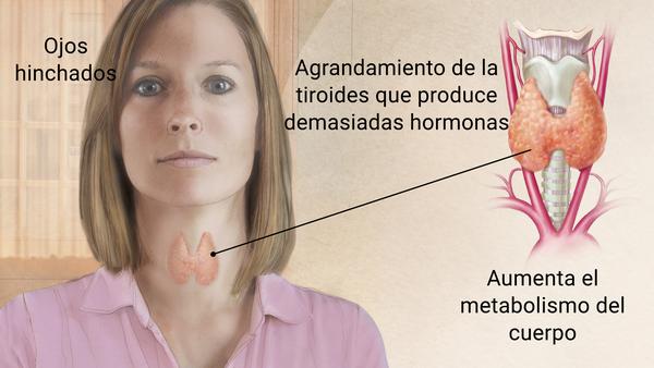 Sintomas de tener tiroides en hombres Sintomas de tener tiroides en hombres