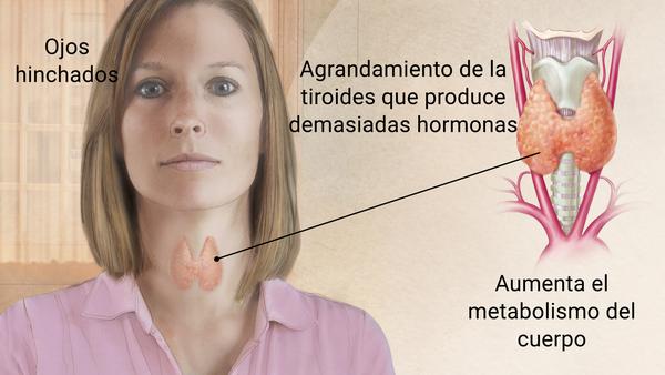 Sintomas de tener tiroides en hombres