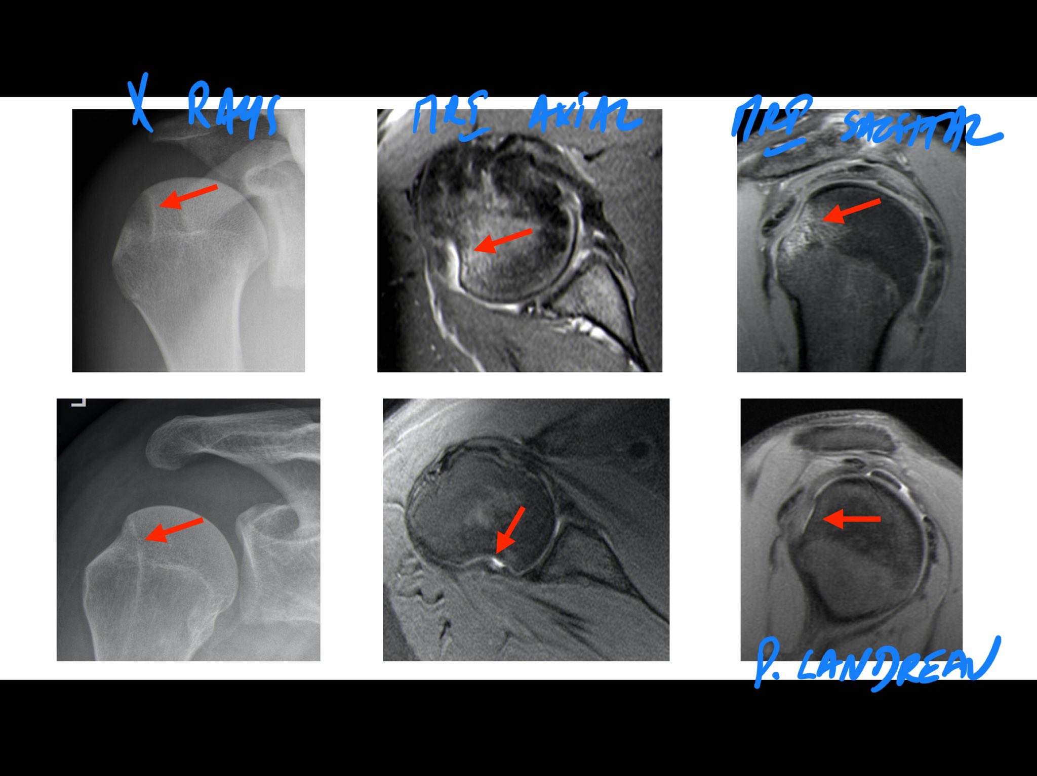 Philippe Landreau, MD on X: Hill-Sachs lesion definition. Just to be sure  everyone is ok with that. 😊  / X