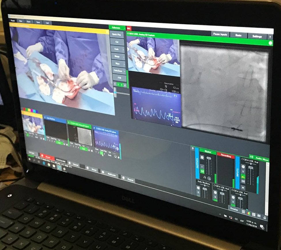 DrBettinotti's tweet image. El correcto uso de #Rotablator nos permite resolver entre un 2-5% de pacientes seleccionados con elevada carga de cálcica en su árbol coronario, que impide la realización de una #Angioplastia exitosa con la técnica convencional balón-stent.

#Cardiologia #TransmisionEnVivo