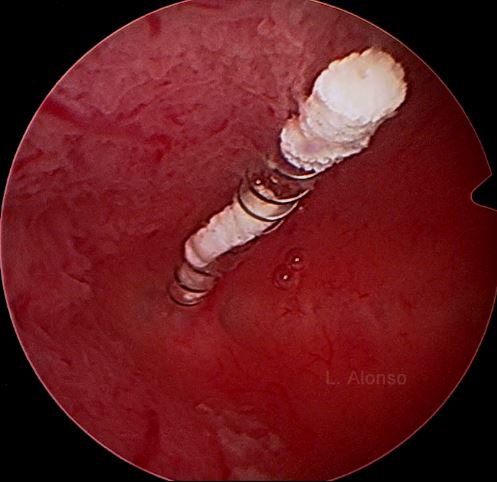 hysteronews's tweet photo. Until now, it is not clear if there is a relationship between reported complaints and formation of calcite deposits on Essure®. Capsule Infrared spectroscopy of deposits on Essure® devices showed a pattern conclusive with calcite. 
#essure
DOI: 10.1016/j.crwh.2017.06.003 https://t.co/QL3nWAgehZ