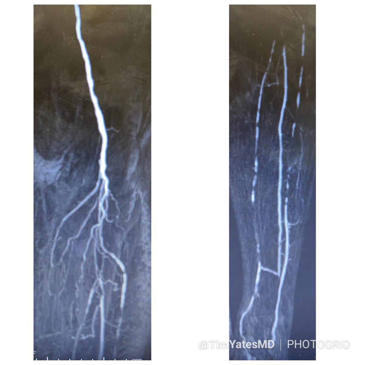 SOBE_Vascular's tweet image. MRA can be MORE sensitive to tibial occlusive disease than DSA. MRA helped plan approach due to knowledge of hibernating AT and peroneal lumen. Successful antegrade luminal recan for #CLI #CLIfighters #mylegmylife @FadiSaab17 @Mustapja @roblookstein @DrBTKatzen @BOlivieriMD