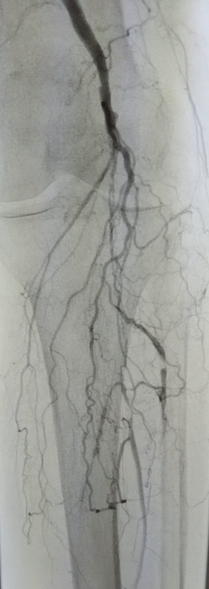 SOBE_Vascular's tweet image. MRA can be MORE sensitive to tibial occlusive disease than DSA. MRA helped plan approach due to knowledge of hibernating AT and peroneal lumen. Successful antegrade luminal recan for #CLI #CLIfighters #mylegmylife @FadiSaab17 @Mustapja @roblookstein @DrBTKatzen @BOlivieriMD