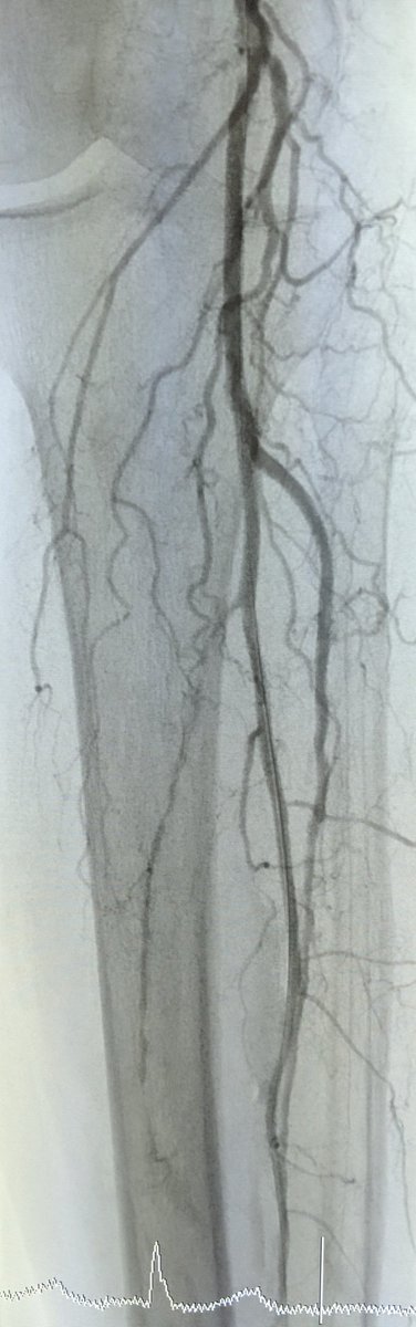 SOBE_Vascular's tweet image. MRA can be MORE sensitive to tibial occlusive disease than DSA. MRA helped plan approach due to knowledge of hibernating AT and peroneal lumen. Successful antegrade luminal recan for #CLI #CLIfighters #mylegmylife @FadiSaab17 @Mustapja @roblookstein @DrBTKatzen @BOlivieriMD