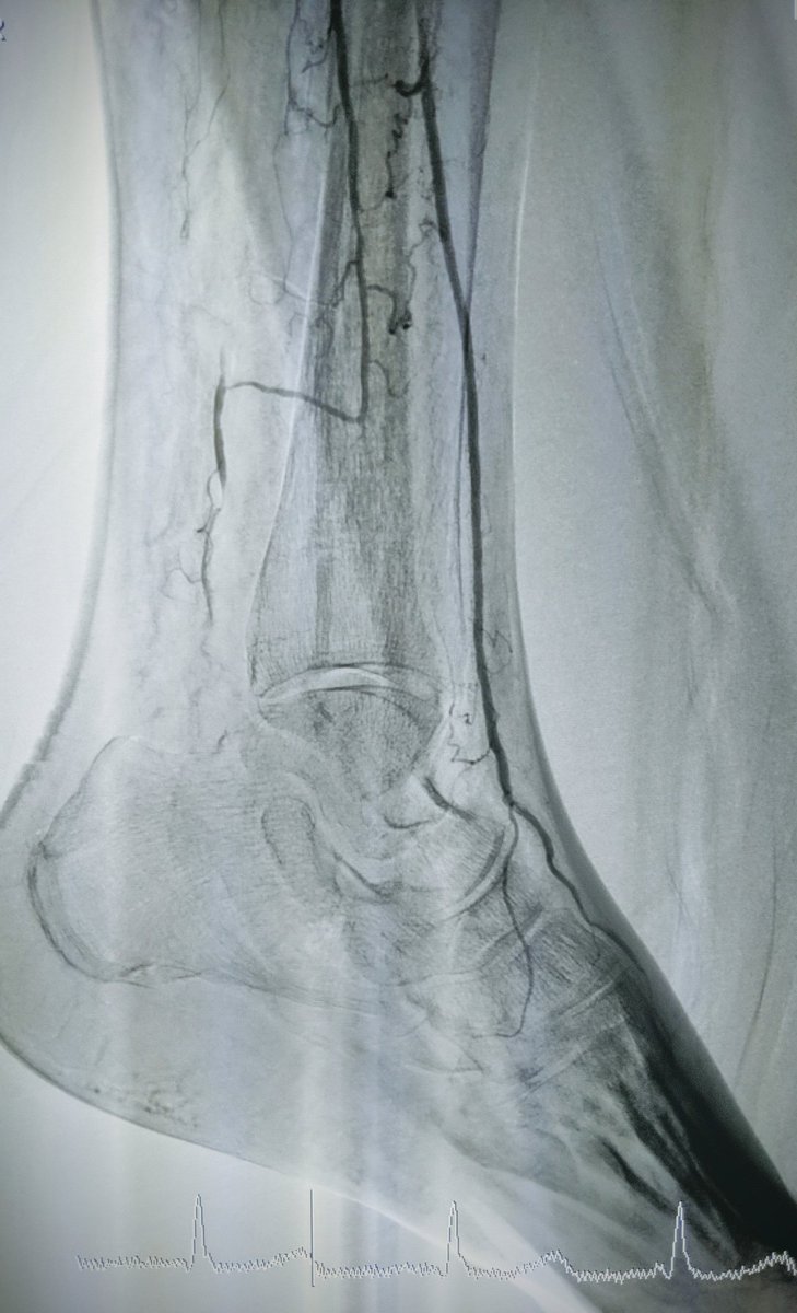 SOBE_Vascular's tweet image. MRA can be MORE sensitive to tibial occlusive disease than DSA. MRA helped plan approach due to knowledge of hibernating AT and peroneal lumen. Successful antegrade luminal recan for #CLI #CLIfighters #mylegmylife @FadiSaab17 @Mustapja @roblookstein @DrBTKatzen @BOlivieriMD