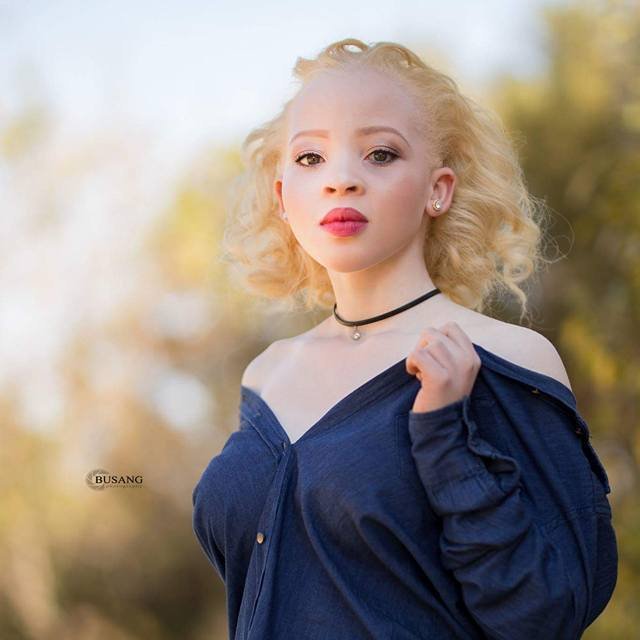 STOP ALBINISM KILLINGS tweet media