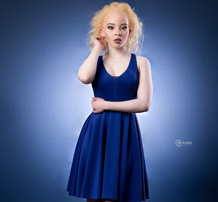 STOP ALBINISM KILLINGS tweet media