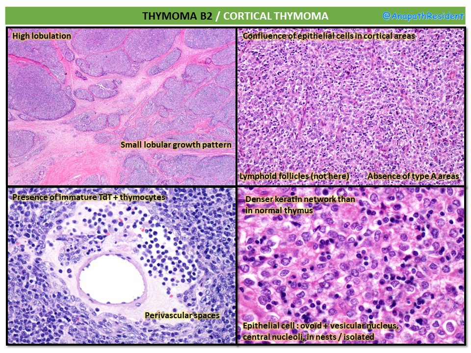 Memo of WHO Histological Classification of Thymoma and Thymic Carcinoma
(2 others pictures in comments). Pictures from WebPathology.
Articles : J Thorac Oncol. 2014 May;9(5):596-611.
#pathclues #pathboards #surgpath #thymoma
@GeronimoJrLapac @ritaescarvalho @slusagar @DrAldehyde