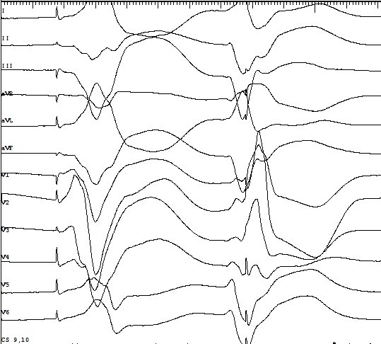 dredcronin's tweet photo. Ablation of a Purkinje fiber PVC triggering VF @hartfordhosp - one of the most challenging, but also most satisfying, procedures we #EPeeps do. Lifesaving. https://t.co/bstkXdWdeK