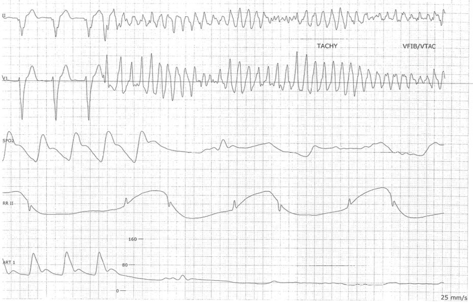 dredcronin's tweet photo. Ablation of a Purkinje fiber PVC triggering VF @hartfordhosp - one of the most challenging, but also most satisfying, procedures we #EPeeps do. Lifesaving. https://t.co/bstkXdWdeK