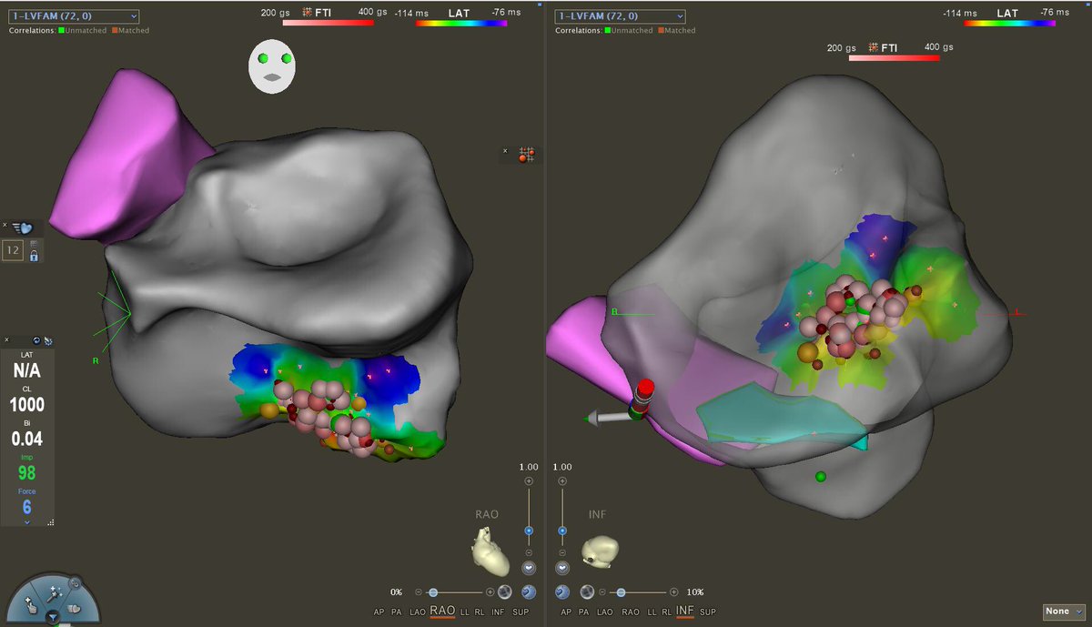 Ablation of a Purkinje fiber PVC triggering VF @hartfordhosp - one of the most challenging, but also most satisfying, procedures we #EPeeps do. Lifesaving.