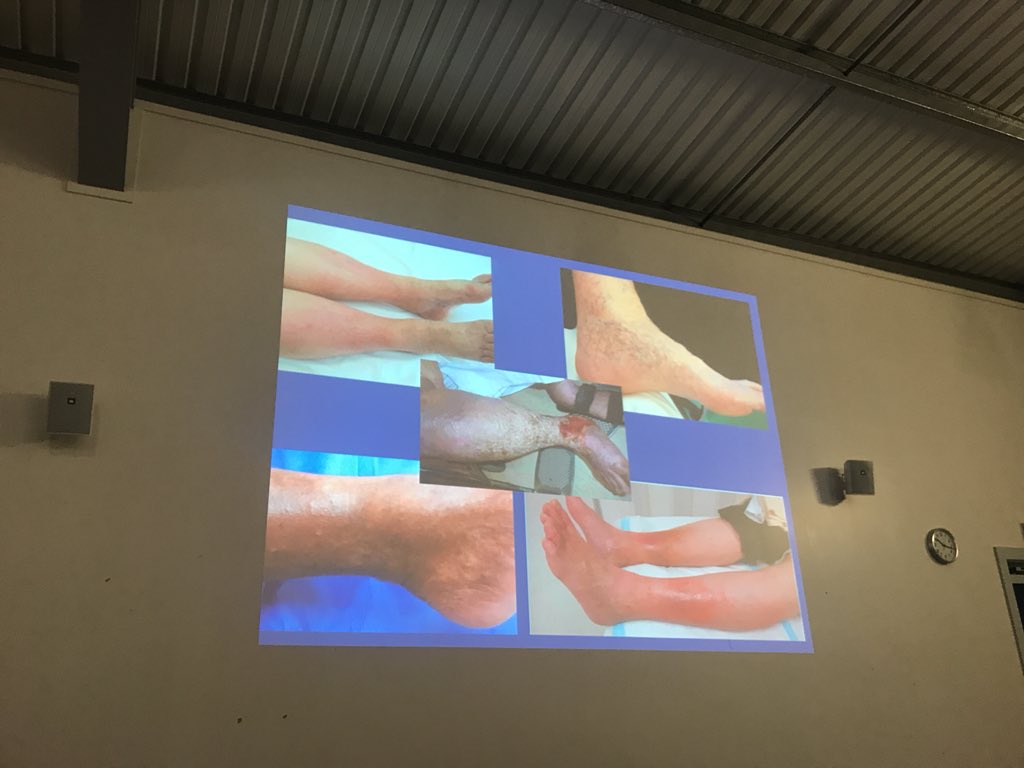 Dr Alexandra Bonsall speaking about varicose eczema. #lowerlimbpathway <a href="/scstring/">Sandra</a> <a href="/FRuss247/">Fiona Russell</a> <a href="/AllyLister1/">Ally Lister</a> <a href="/NHSGrampian/">NHS Grampian</a> <a href="/ethelpeterhead/">Ethel Wilson</a> <a href="/katetvn/">Kate Watson</a> <a href="/katedn02/">Kathleen Taylor</a>