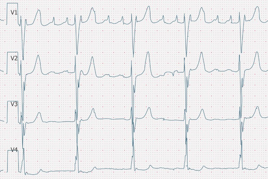 ecgbuddy's tweet photo. Time for a fresh ECG case. Do you know what's happening here? Have a great one!
Your patient complains of palpitations.
What's wrong? #ECG #ecgbuddy #studybuddy #doctopia #ecginterpretation #ecgcourse #emergencyroom #hospitallife #medschool #medicallife #ERlife #doctorslife https://t.co/WBXjvLqRb4