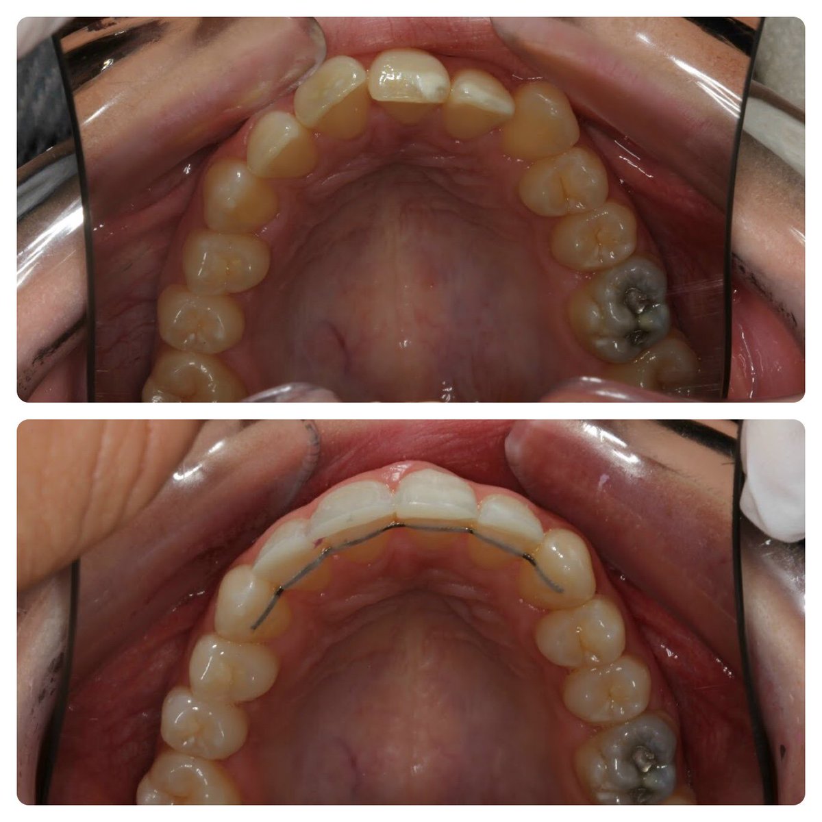 TeethSolutions's tweet image. Interested in whitening and straightening from £5.35 a day with 0% finance?
Why not book in for a free consultation to see what we have to offer. 
•
•
Contact our patient experience team on 01670514472 or newgatedentalsolutions.co.uk #beforeandafter #perfectsmile #orthodontics