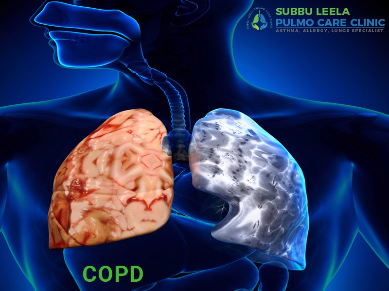 subbuleelapulmo's tweet photo. Chronic obstructive pulmonary disease (COPD) is a chronic #disease characterized by shortness of #breath, #cough and sputum production.
Contact: +91-78455 01546 
https://t.co/hr5XlljFKm
#COPD #lung #lungdiseases #emphysema #asthma #hospital #clinic https://t.co/YoZhZiEBOl
