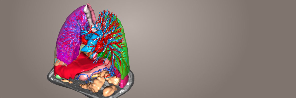 medflixs's tweet photo. Visible Patient : Visualisez le modèle 3D des Patients afin de favoriser l'approche thérapeutique !
#vivatech2018 #plannification #chirurgie #visualisation3D #sante #digitalhealth #Medtech #esante #medecins #innovation #medicale #Medflixs @VisiblePatient https://t.co/isYwOrX17D https://t.co/5QDvq4R5dY