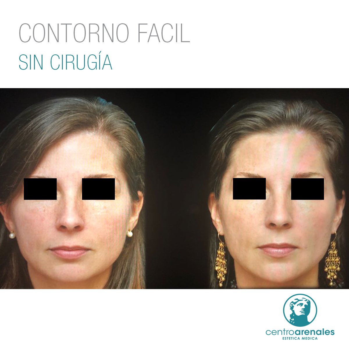 CentroArenales's tweet photo. ✨ Modificación del #Contorno #Facial sin cirugía!✨
🔹 De un rostro cuadrado, hemos pasado a un rostro oval, gracias a la #voluminización del #mentón.
 🔹 Así mismo se realizó Botox en tercio superior para relajar la mirada y hacerla más juvenil! 

✉ Consultanos!
📞 4812.5577 https://t.co/9o7R0pj7En