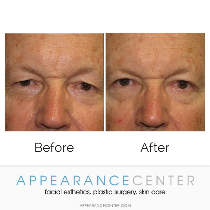 AppearanceCNTR's tweet photo. An upper #blepharoplasty, or eyelid surgery, can make one appear more awake, increase vision (depending on severity of the #eyelid sag), and create an all around softer look. Call today to schedule a consultation: (949) 200-1615 https://t.co/u3SbLKNYEs