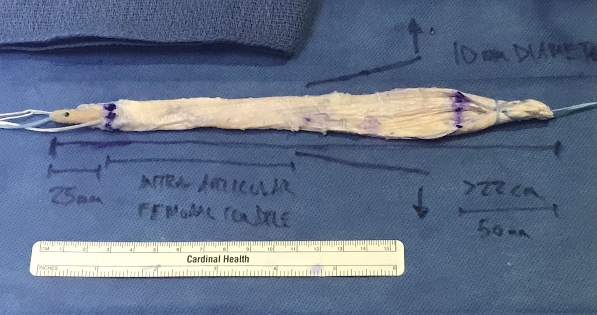 bill_weiss's tweet image. Coming soon to a multiple ligament injured or dislocated knee near you... assuming results continue to be good! 🤞🏻#KneeDislocation #MultiLigKnee #AnatomicReconstruction #2with1Graft #TechniquePaper #CohortStudy